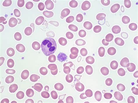 Sideroblastic Anemia – A Laboratory Guide to Clinical .